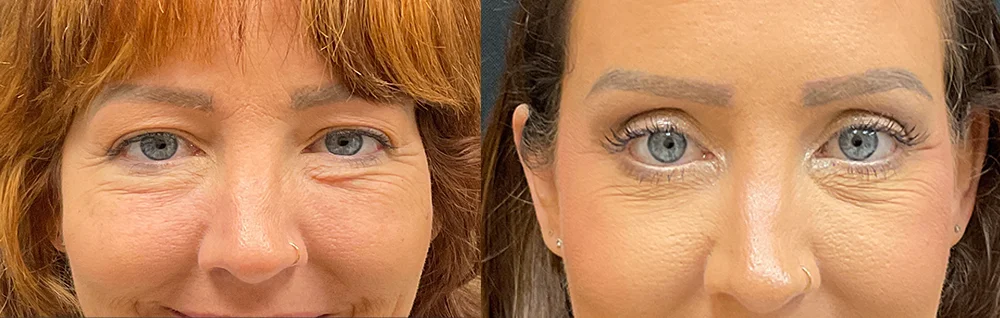 Before and after oculofacial plastic surgery results in Atlanta, GA, performed by Dr. Sahitya Reddy.