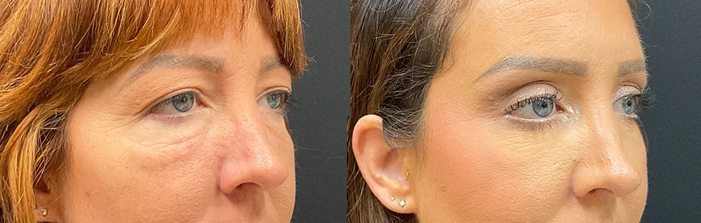 Before and after oculofacial plastic surgery results in Atlanta, GA, performed by Dr. Sahitya Reddy.