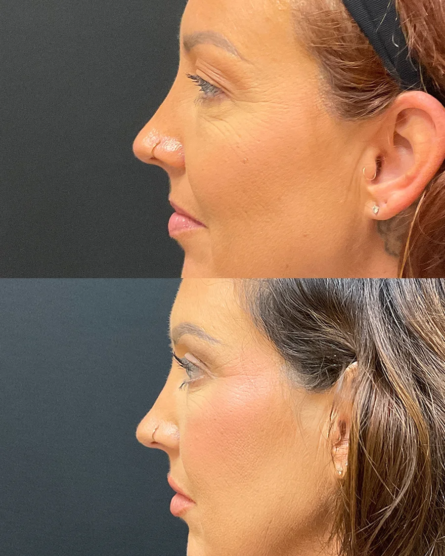 crystal-lateral-left-01