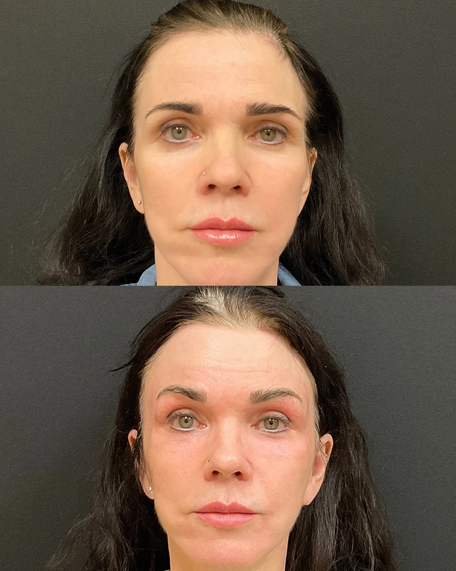 Before and after oculofacial plastic surgery results in Atlanta, GA, performed by Dr. Sahitya Reddy.