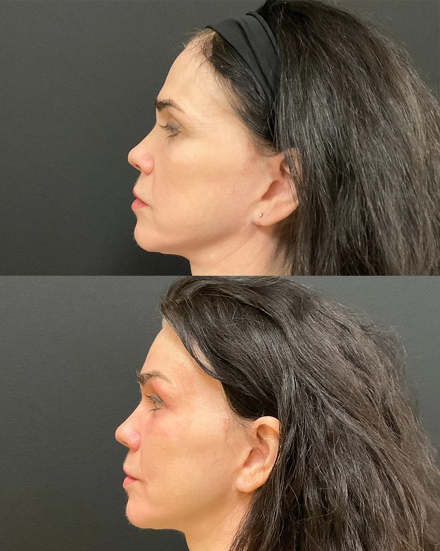 Before and after oculofacial plastic surgery results in Atlanta, GA, performed by Dr. Sahitya Reddy.