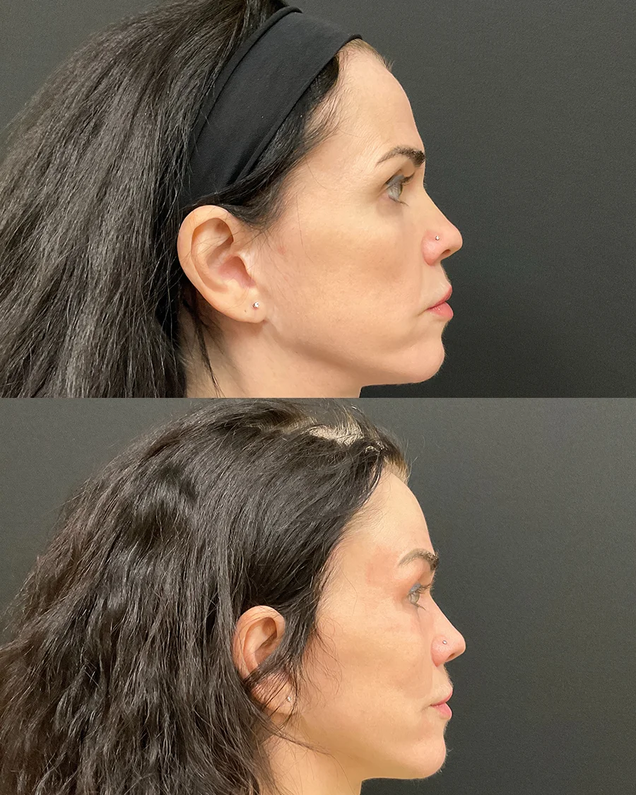 Before and after oculofacial plastic surgery results in Atlanta, GA, performed by Dr. Sahitya Reddy.