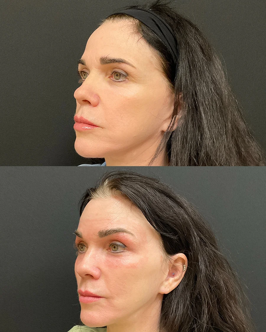 Before and after oculofacial plastic surgery results in Atlanta, GA, performed by Dr. Sahitya Reddy.