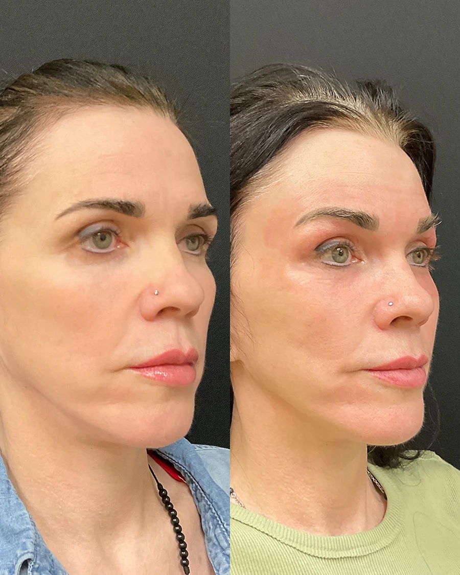 Before and after oculofacial plastic surgery results in Atlanta, GA, performed by Dr. Sahitya Reddy.
