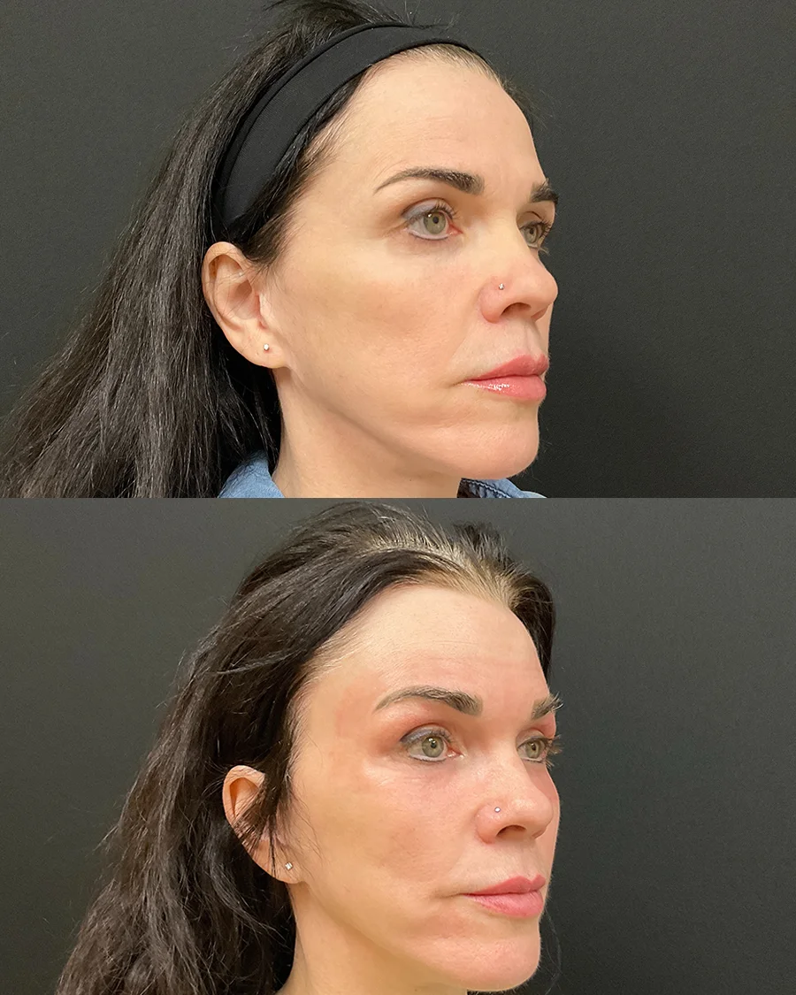 Before and after oculofacial plastic surgery results in Atlanta, GA, performed by Dr. Sahitya Reddy.