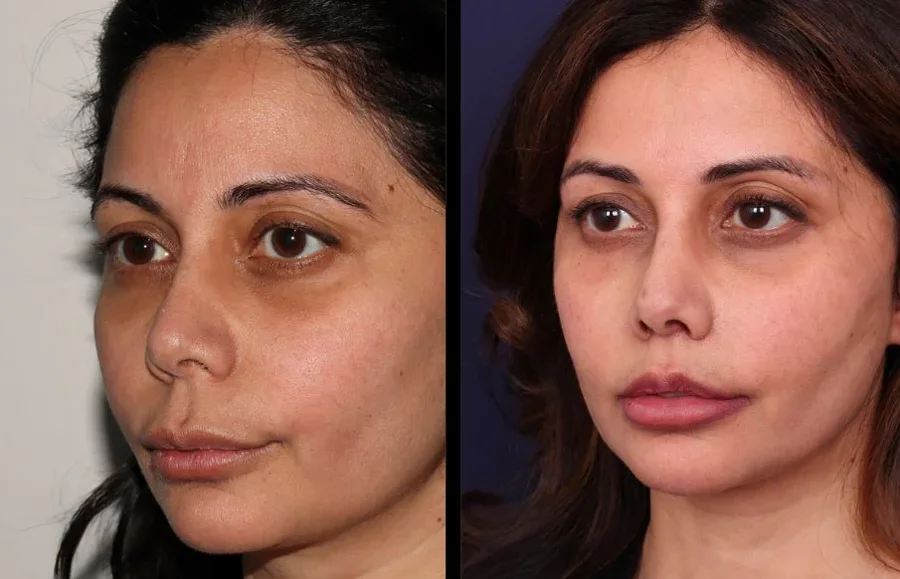 Before and after oculofacial plastic surgery results in Atlanta, GA, performed by Dr. Sahitya Reddy.