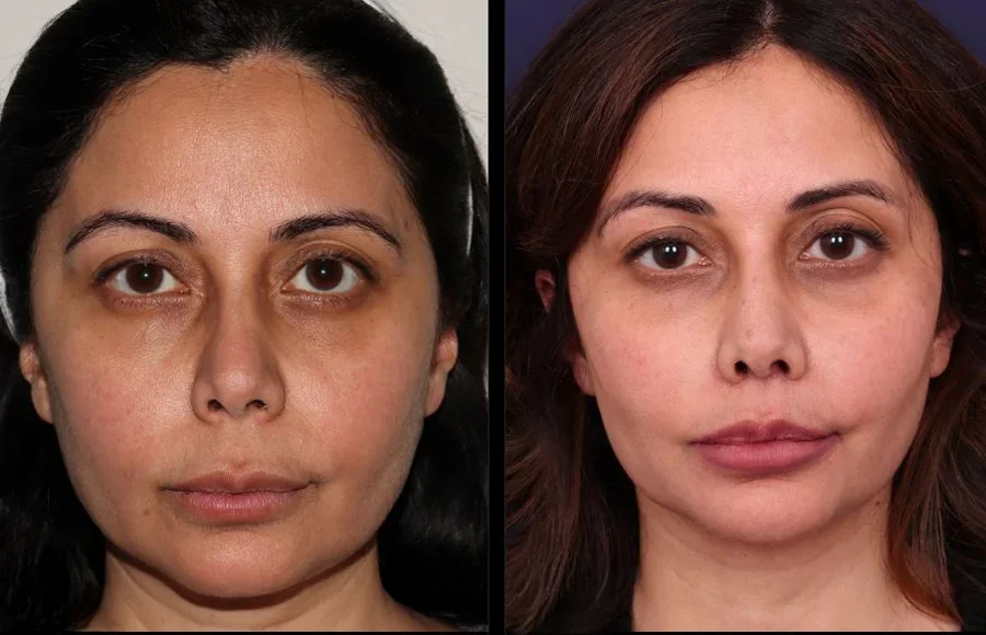 Before and after oculofacial plastic surgery results in Atlanta, GA, performed by Dr. Sahitya Reddy.