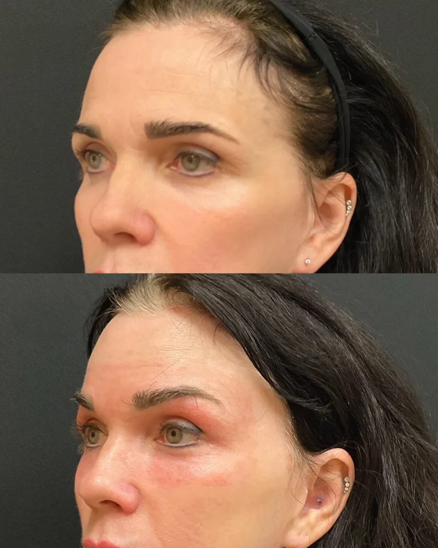 Before and after oculofacial plastic surgery results in Atlanta, GA, performed by Dr. Sahitya Reddy.