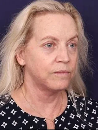 Before and after oculofacial plastic surgery results in Atlanta, GA, performed by Dr. Sahitya Reddy.