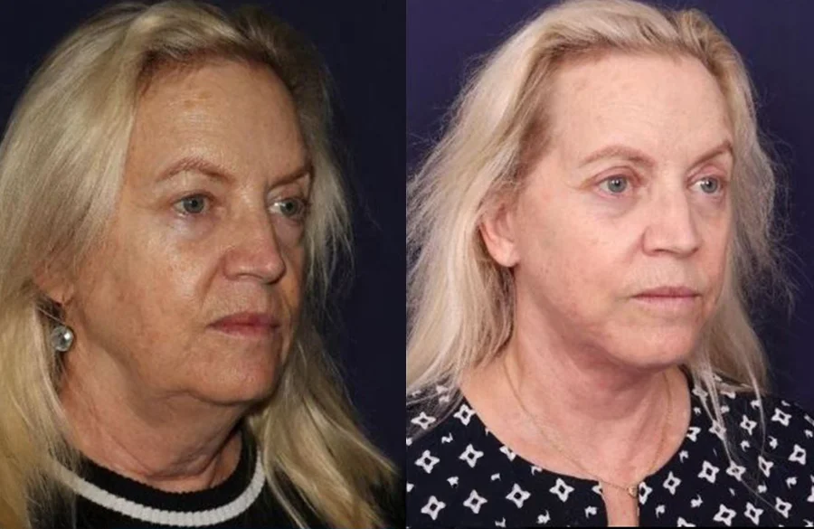 Before and after oculofacial plastic surgery results in Atlanta, GA, performed by Dr. Sahitya Reddy.