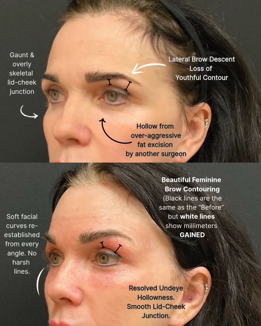 Before and after oculofacial plastic surgery results in Atlanta, GA, performed by Dr. Sahitya Reddy.