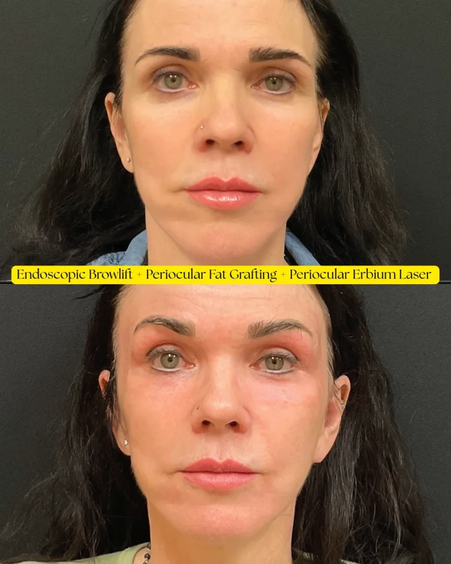 Before and after oculofacial plastic surgery results in Atlanta, GA, performed by Dr. Sahitya Reddy.