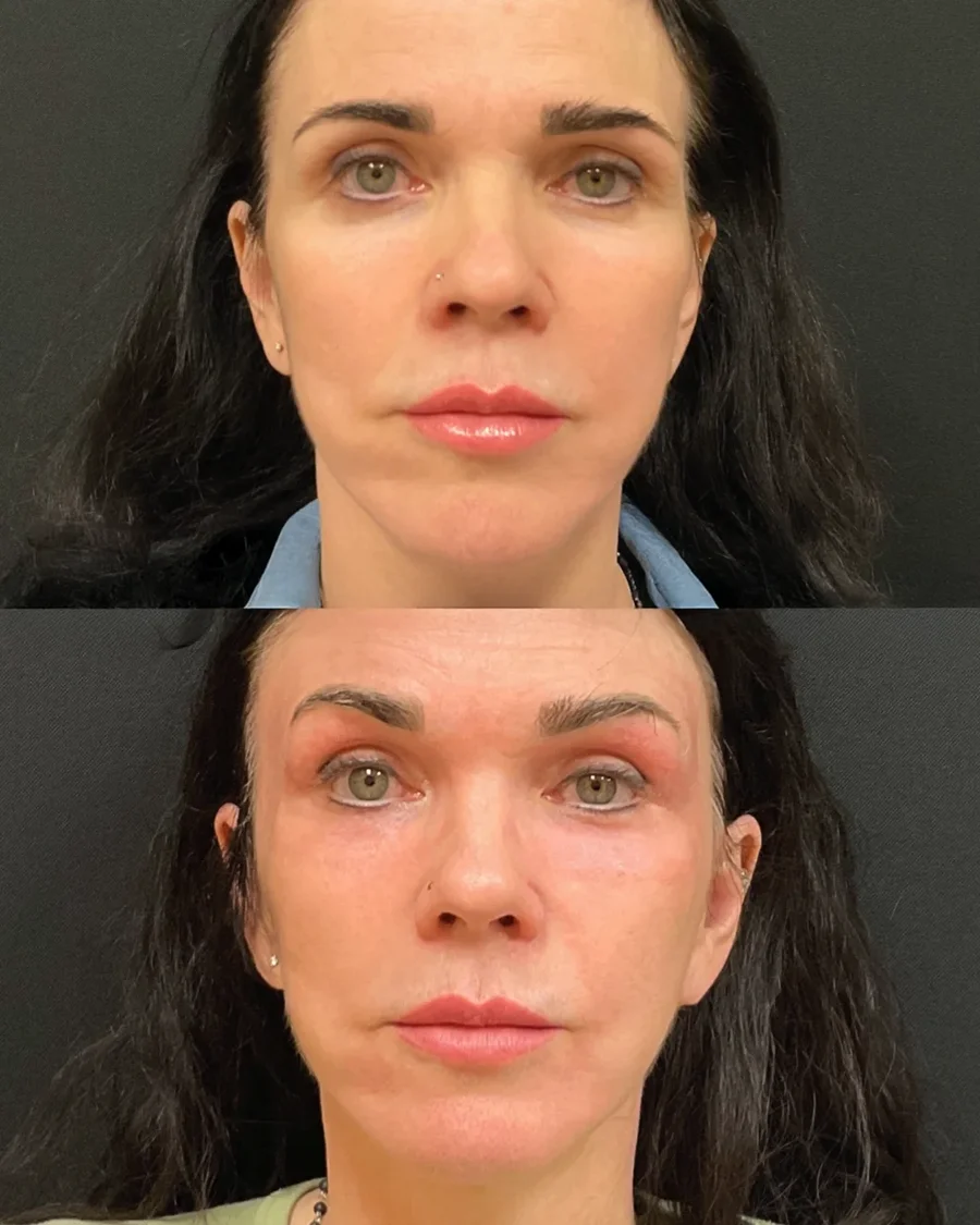 Before and after oculofacial plastic surgery results in Atlanta, GA, performed by Dr. Sahitya Reddy.