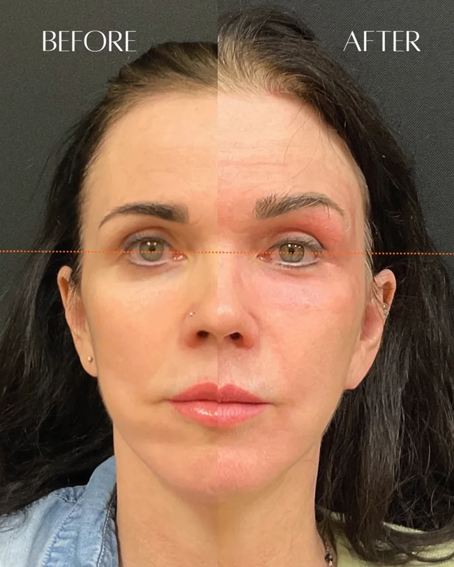 Before and after oculofacial plastic surgery results in Atlanta, GA, performed by Dr. Sahitya Reddy.