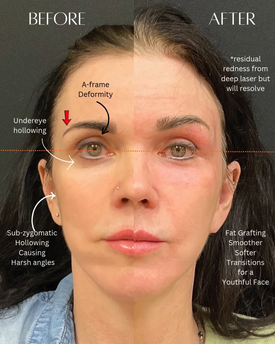 Before and after oculofacial plastic surgery results in Atlanta, GA, performed by Dr. Sahitya Reddy.
