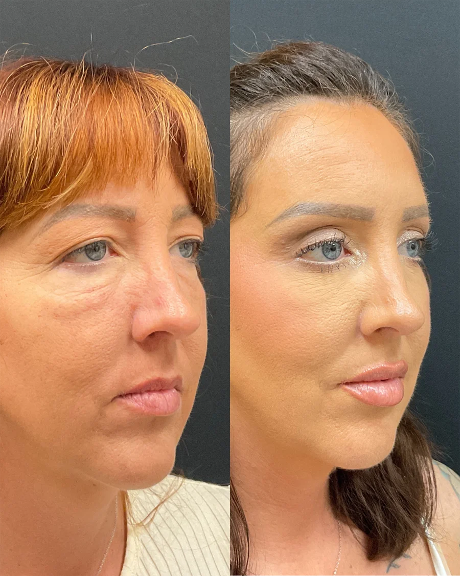 Before and after oculofacial plastic surgery results in Atlanta, GA, performed by Dr. Sahitya Reddy.