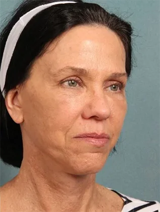 Before and after oculofacial plastic surgery results in Atlanta, GA, performed by Dr. Sahitya Reddy.