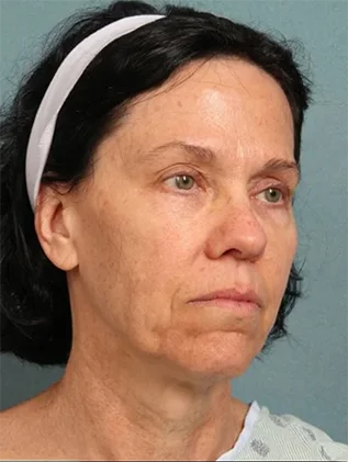 Before and after oculofacial plastic surgery results in Atlanta, GA, performed by Dr. Sahitya Reddy.