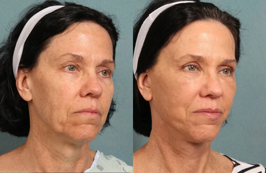 Before and after oculofacial plastic surgery results in Atlanta, GA, performed by Dr. Sahitya Reddy.