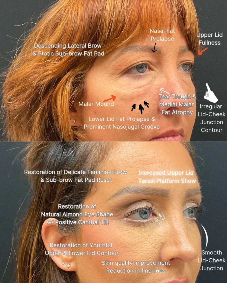 Before and after oculofacial plastic surgery results in Atlanta, GA, performed by Dr. Sahitya Reddy.
