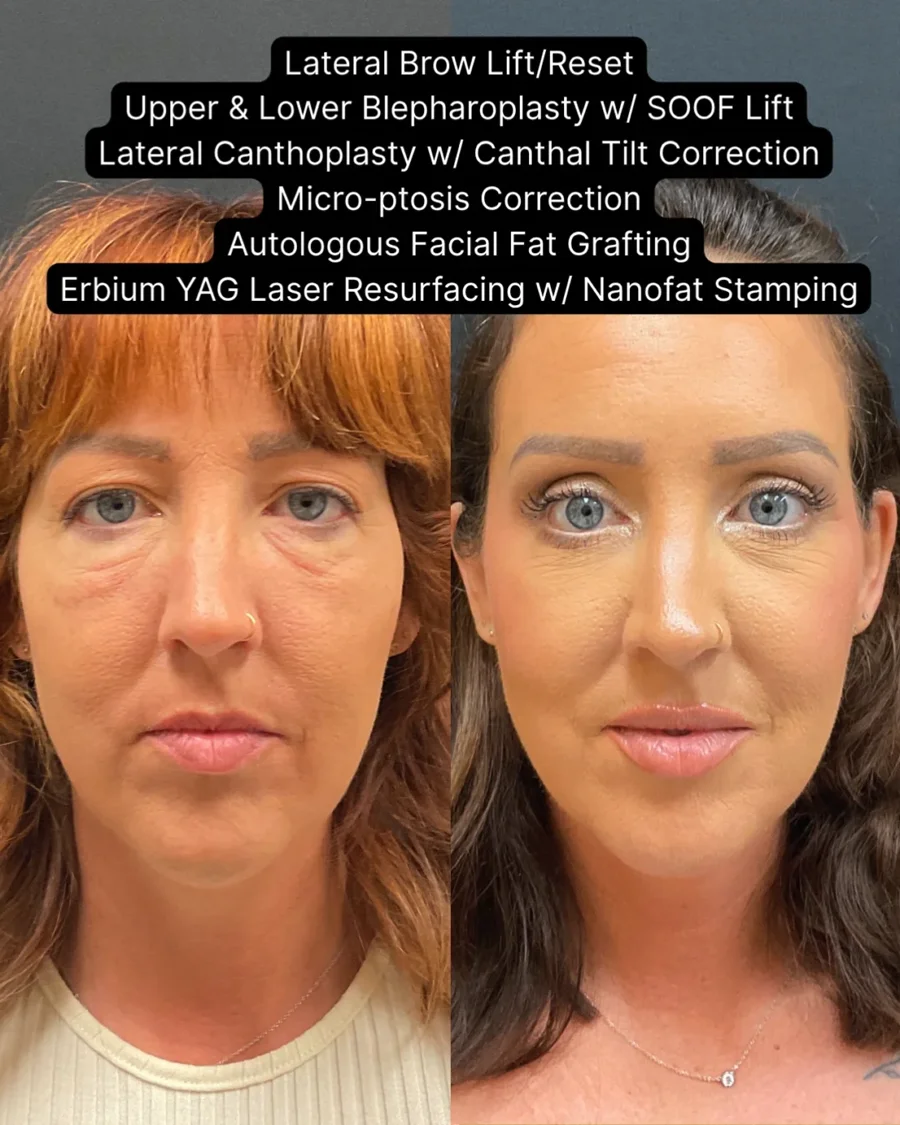 Before and after oculofacial plastic surgery results in Atlanta, GA, performed by Dr. Sahitya Reddy.