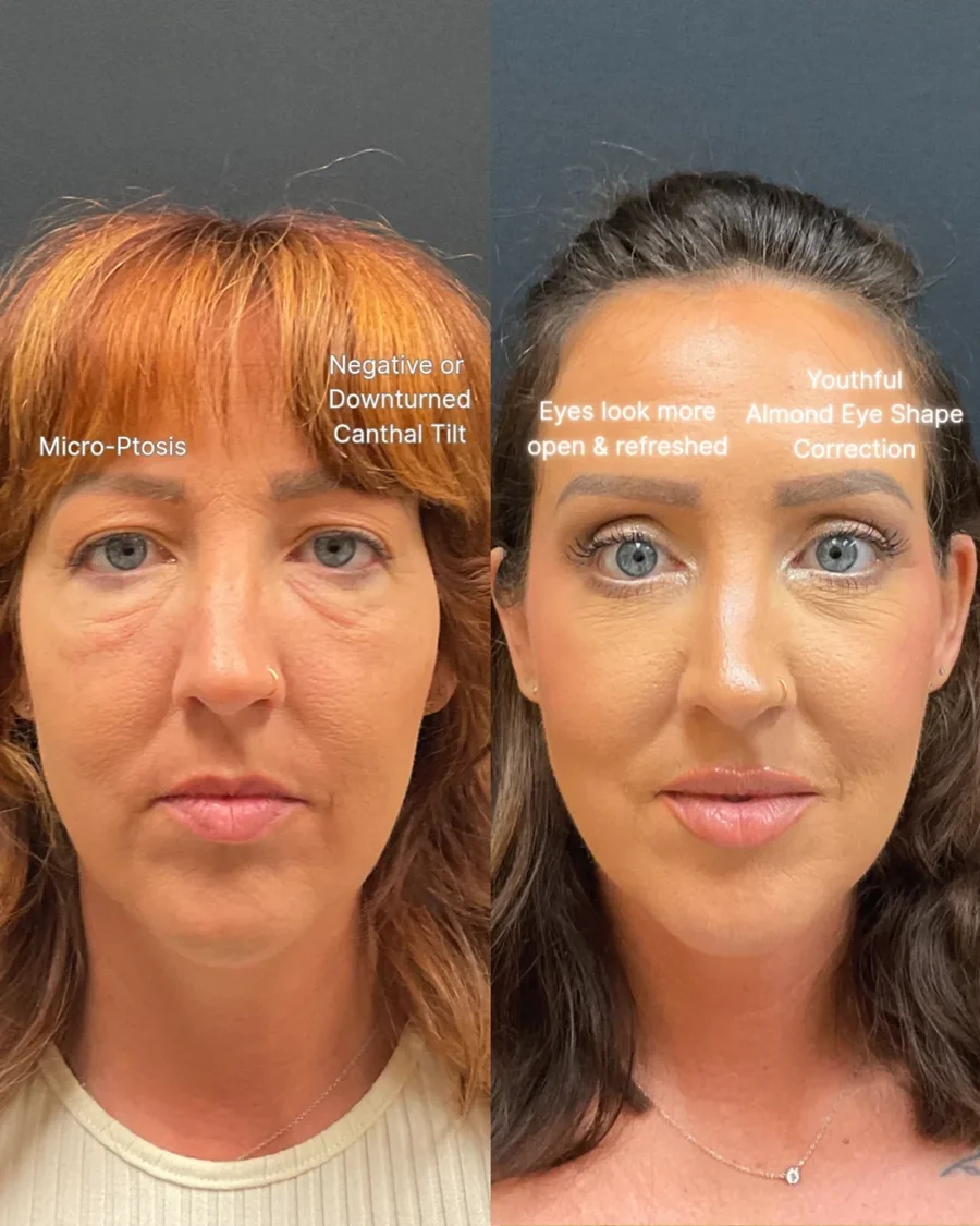 Before and after oculofacial plastic surgery results in Atlanta, GA, performed by Dr. Sahitya Reddy.