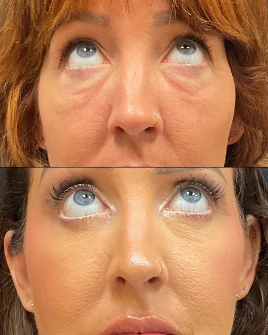 Before and after oculofacial plastic surgery results in Atlanta, GA, performed by Dr. Sahitya Reddy.
