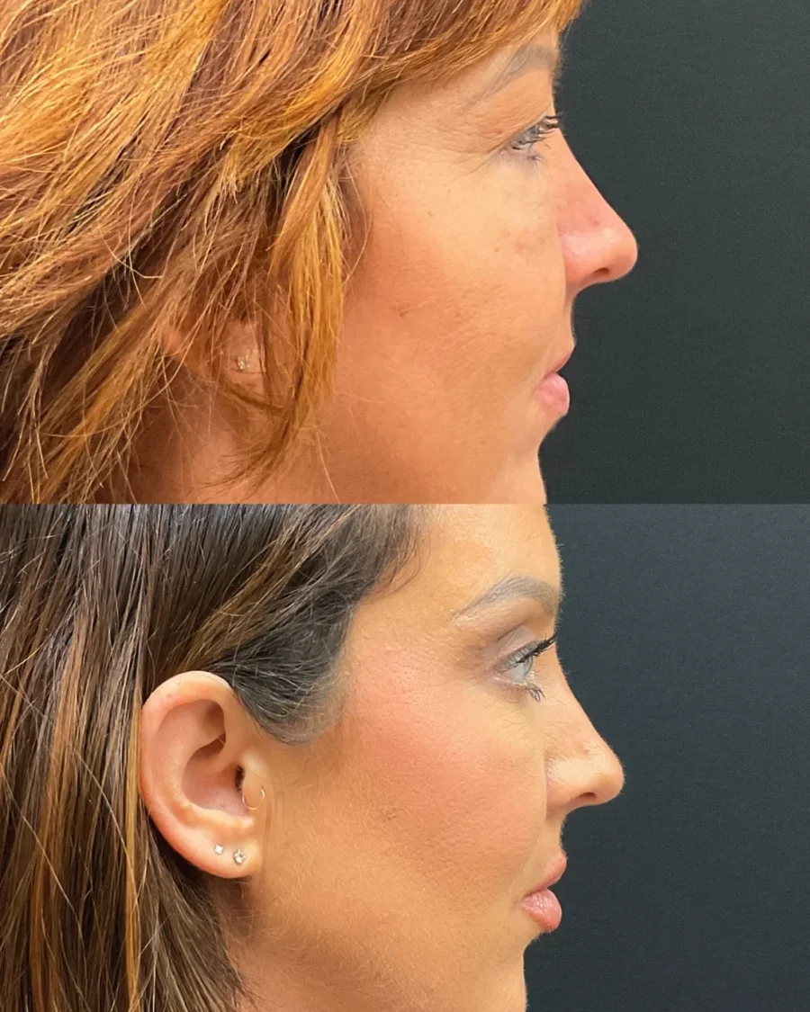 Before and after oculofacial plastic surgery results in Atlanta, GA, performed by Dr. Sahitya Reddy.