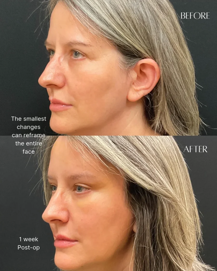 Before and after oculofacial plastic surgery results in Atlanta, GA, performed by Dr. Sahitya Reddy.