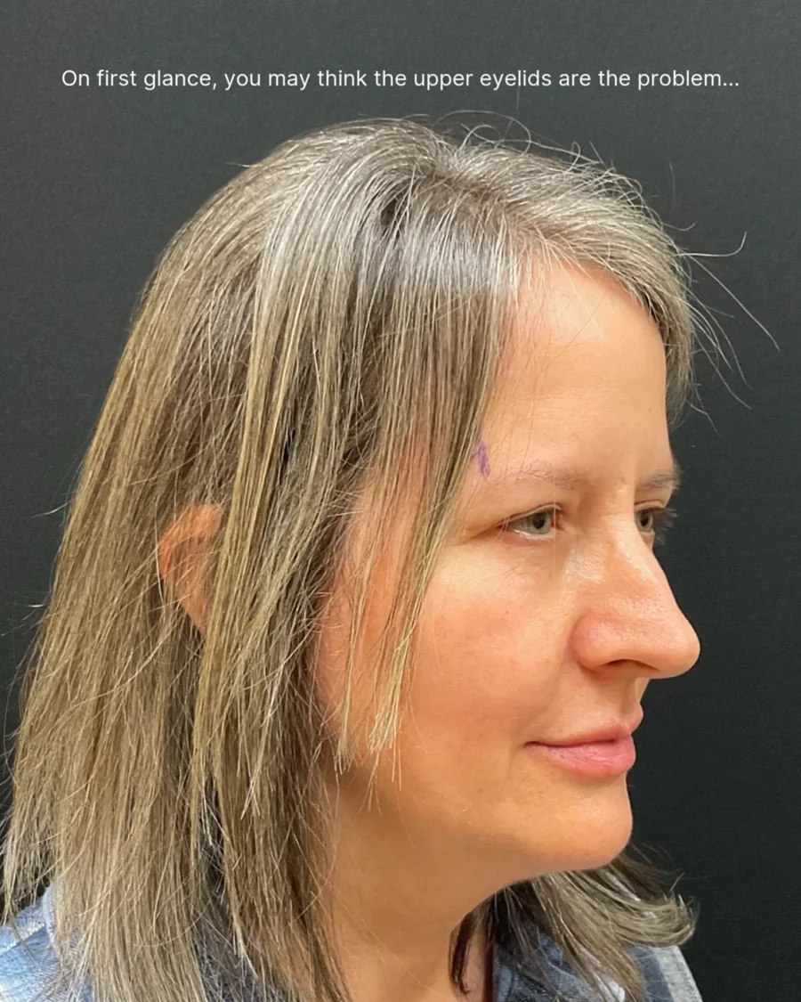 Before and after oculofacial plastic surgery results in Atlanta, GA, performed by Dr. Sahitya Reddy.
