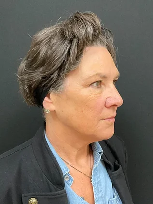 Before and after oculofacial plastic surgery results in Atlanta, GA, performed by Dr. Sahitya Reddy.