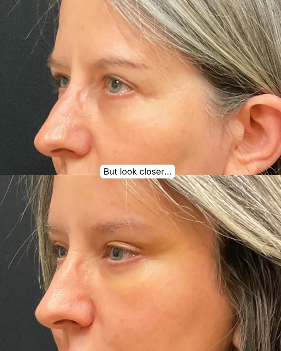 Before and after oculofacial plastic surgery results in Atlanta, GA, performed by Dr. Sahitya Reddy.