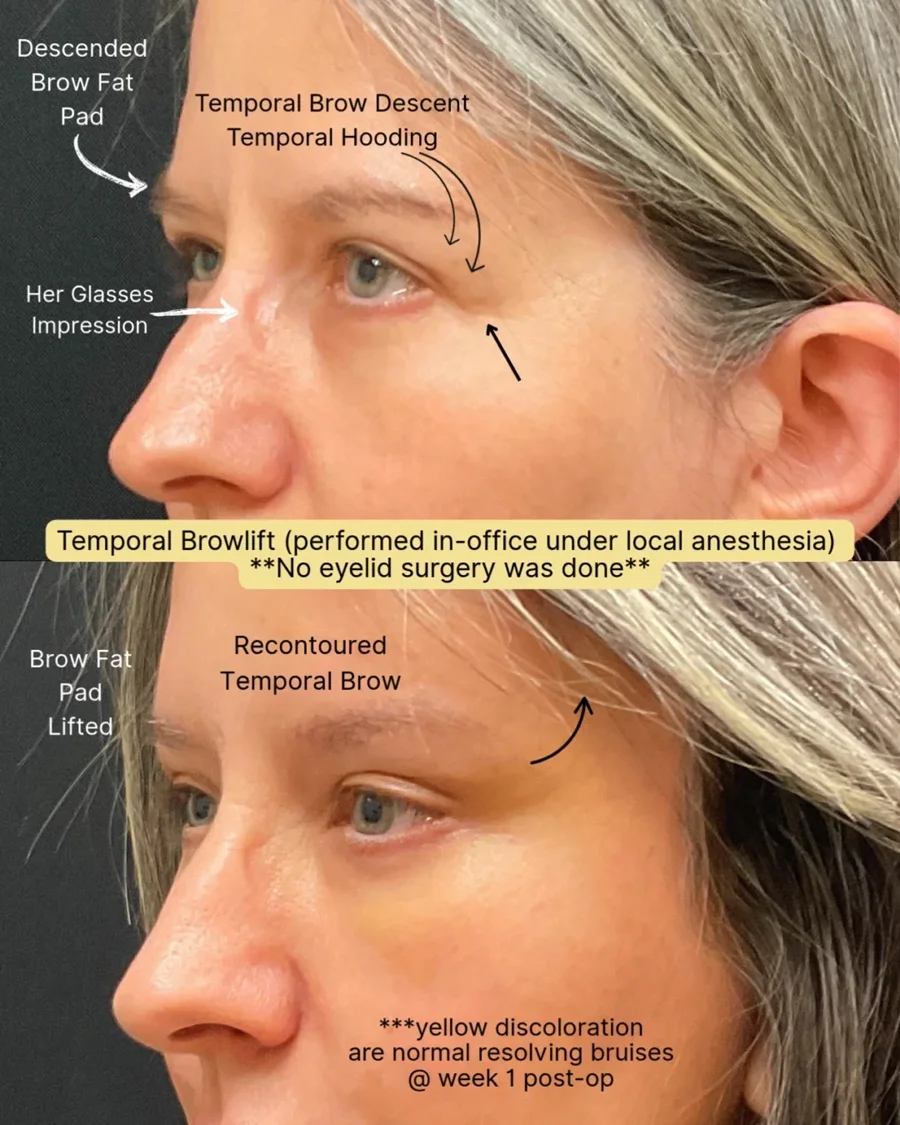 Before and after oculofacial plastic surgery results in Atlanta, GA, performed by Dr. Sahitya Reddy.