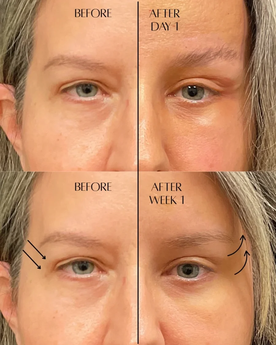 Before and after oculofacial plastic surgery results in Atlanta, GA, performed by Dr. Sahitya Reddy.