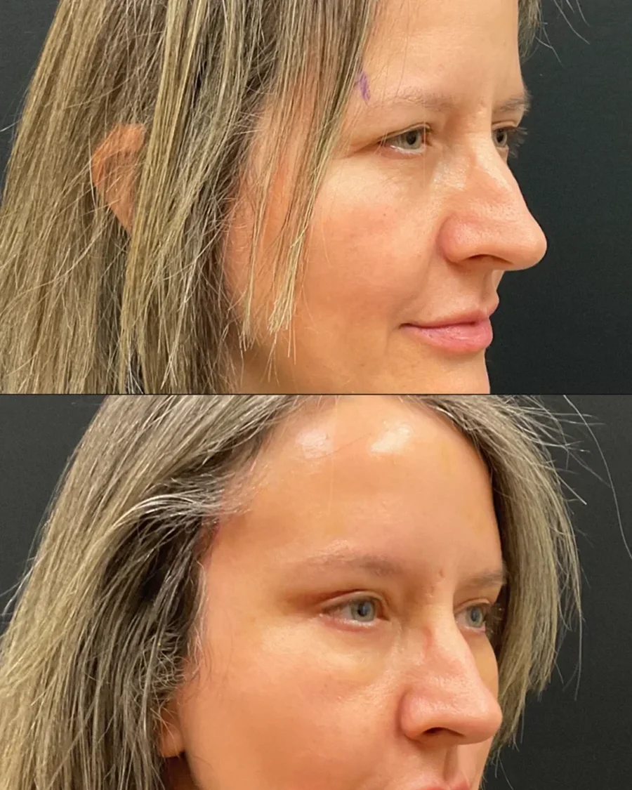 Before and after oculofacial plastic surgery results in Atlanta, GA, performed by Dr. Sahitya Reddy.