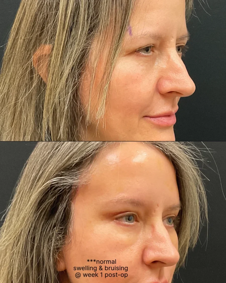 Before and after oculofacial plastic surgery results in Atlanta, GA, performed by Dr. Sahitya Reddy.