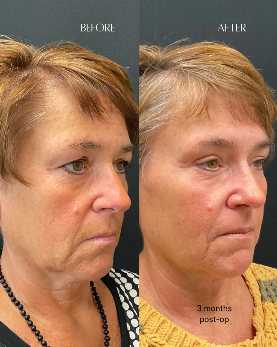 Before and after oculofacial plastic surgery results in Atlanta, GA, performed by Dr. Sahitya Reddy.