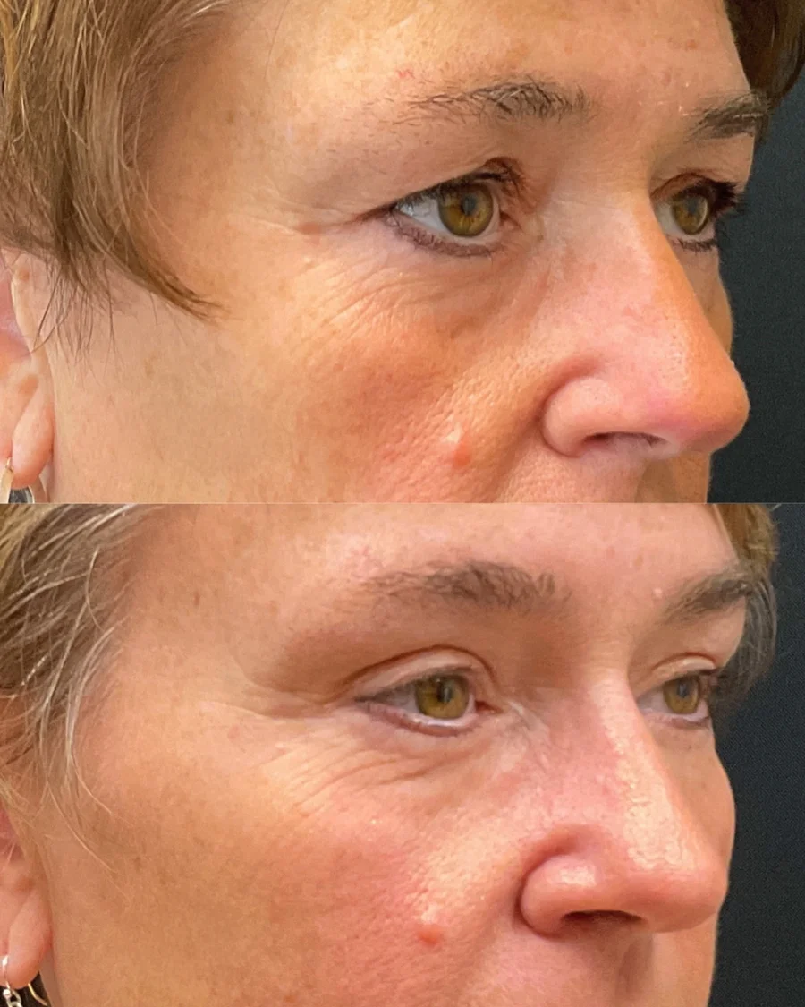 Before and after oculofacial plastic surgery results in Atlanta, GA, performed by Dr. Sahitya Reddy.
