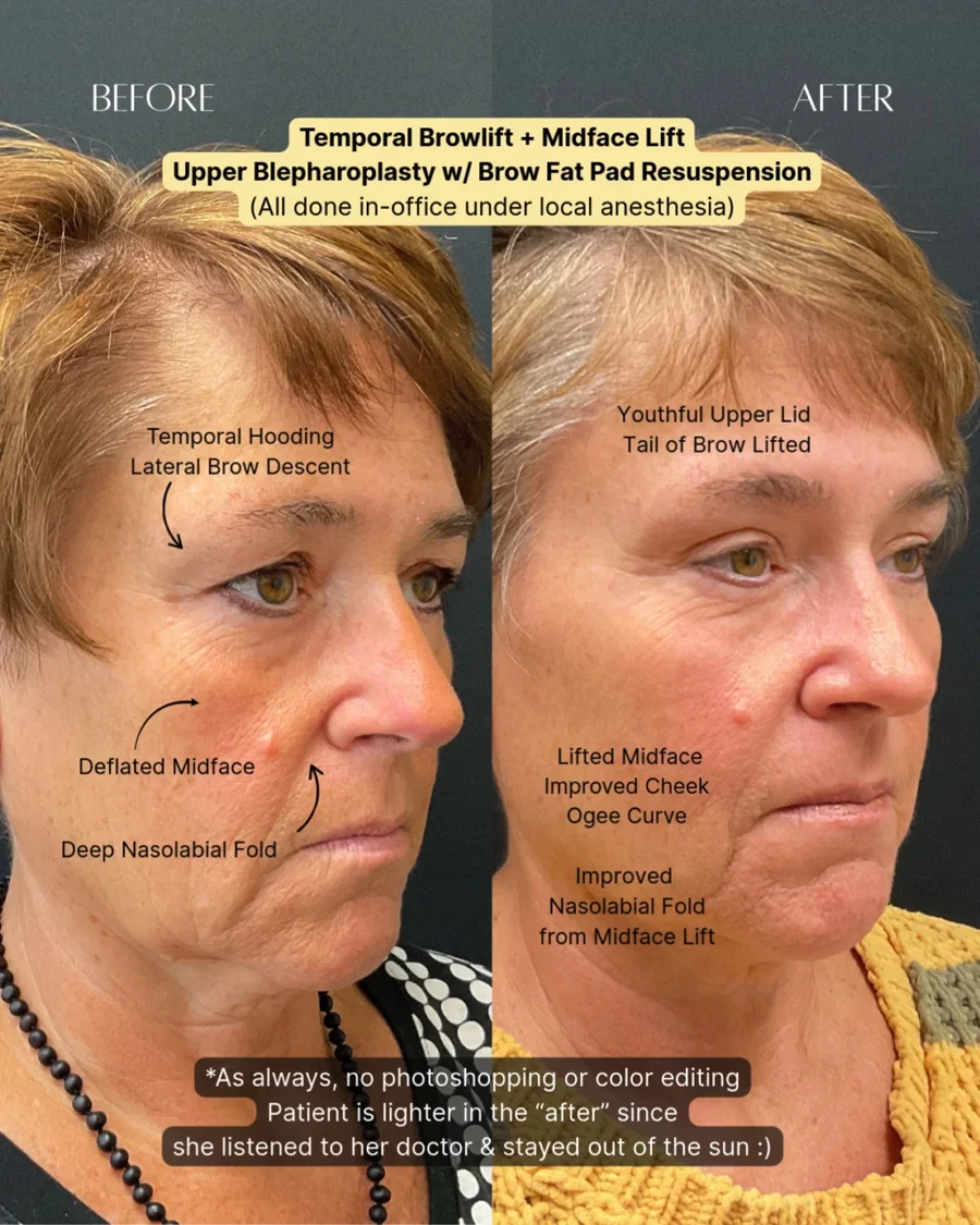 Before and after oculofacial plastic surgery results in Atlanta, GA, performed by Dr. Sahitya Reddy.