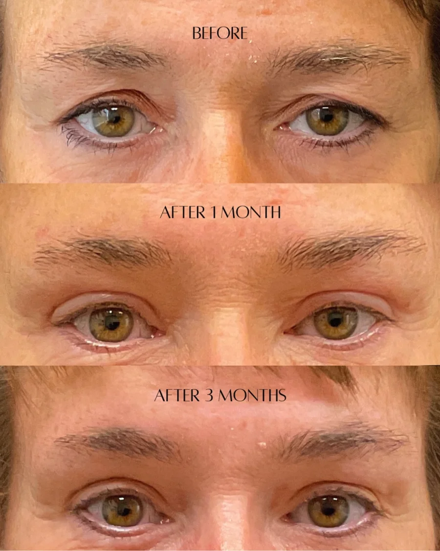 Before and after oculofacial plastic surgery results in Atlanta, GA, performed by Dr. Sahitya Reddy.