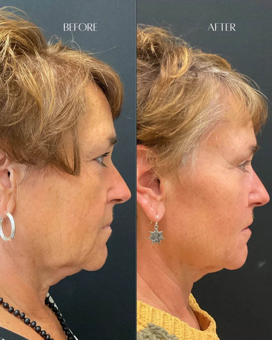 Before and after oculofacial plastic surgery results in Atlanta, GA, performed by Dr. Sahitya Reddy.