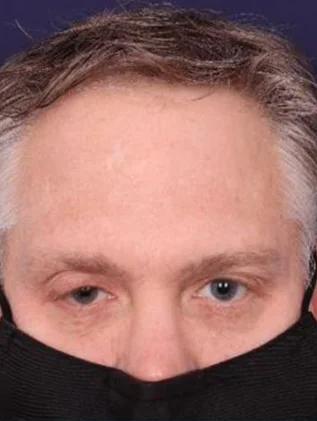 Before and after oculofacial plastic surgery results in Atlanta, GA, performed by Dr. Sahitya Reddy.