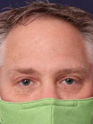 Before and after oculofacial plastic surgery results in Atlanta, GA, performed by Dr. Sahitya Reddy.
