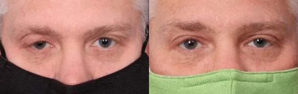 Before and after oculofacial plastic surgery results in Atlanta, GA, performed by Dr. Sahitya Reddy.