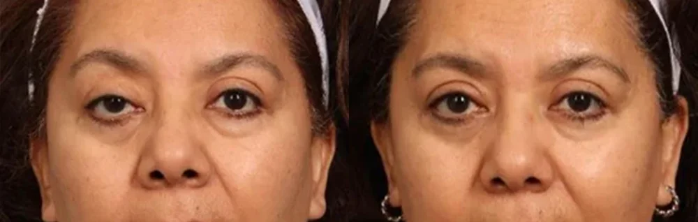 Before and after oculofacial plastic surgery results in Atlanta, GA, performed by Dr. Sahitya Reddy.