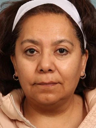 Before and after oculofacial plastic surgery results in Atlanta, GA, performed by Dr. Sahitya Reddy.