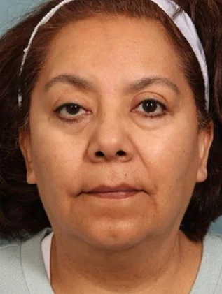Before and after oculofacial plastic surgery results in Atlanta, GA, performed by Dr. Sahitya Reddy.