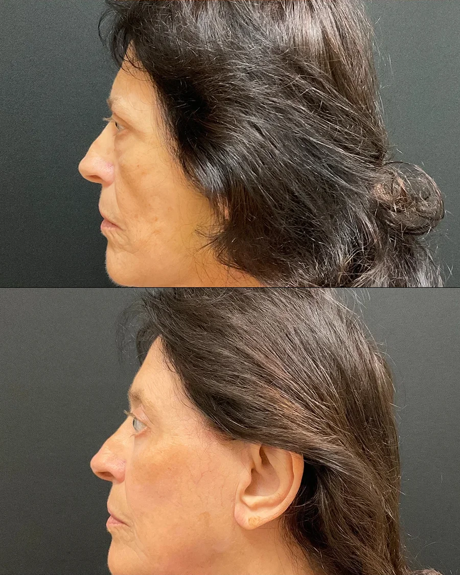 rosemary-lateral-left-02