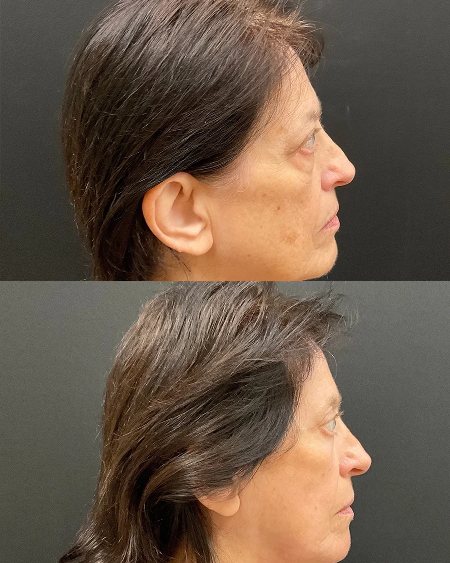 rosemary-lateral-right-01