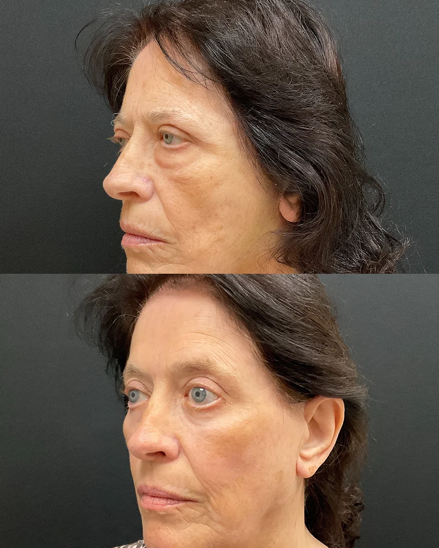 rosemary-oblique-left-01